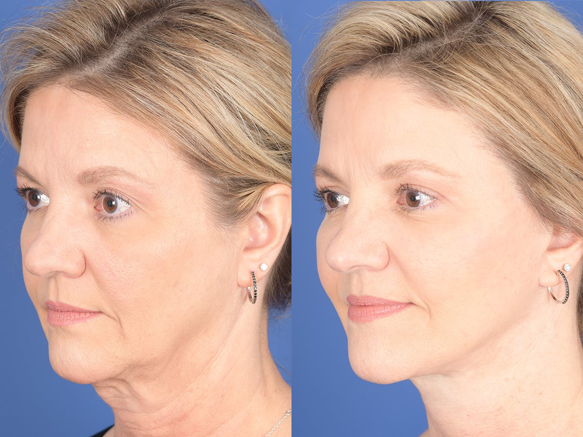 Facelift Before & After Gallery - Patient 807378 - Image 3