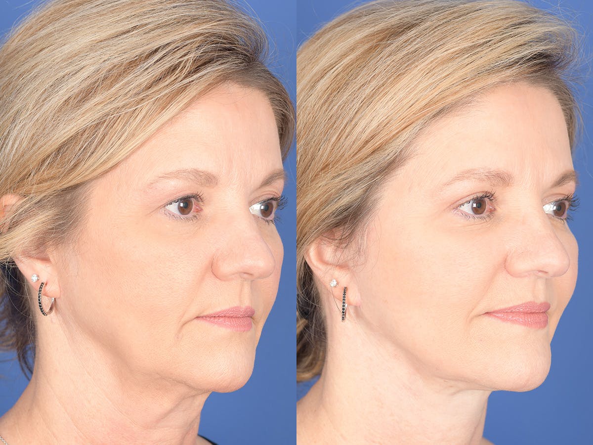 Facelift Before & After Gallery - Patient 807378 - Image 4