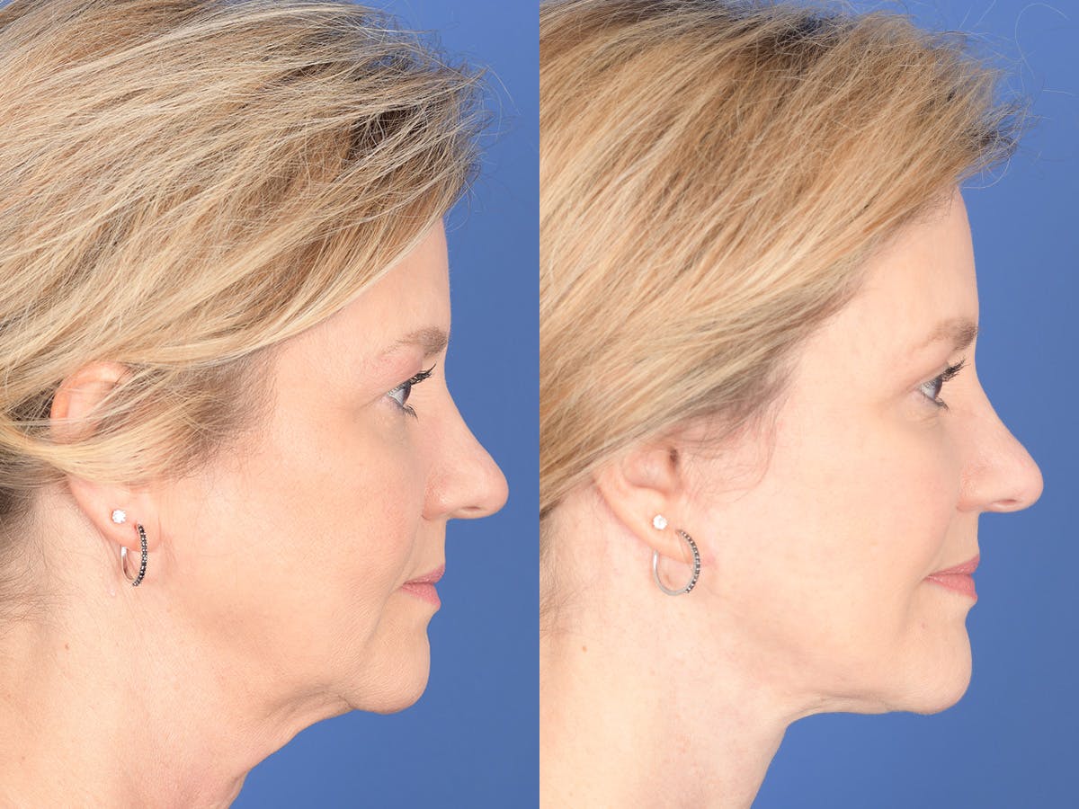 Facelift Before & After Gallery - Patient 807378 - Image 5