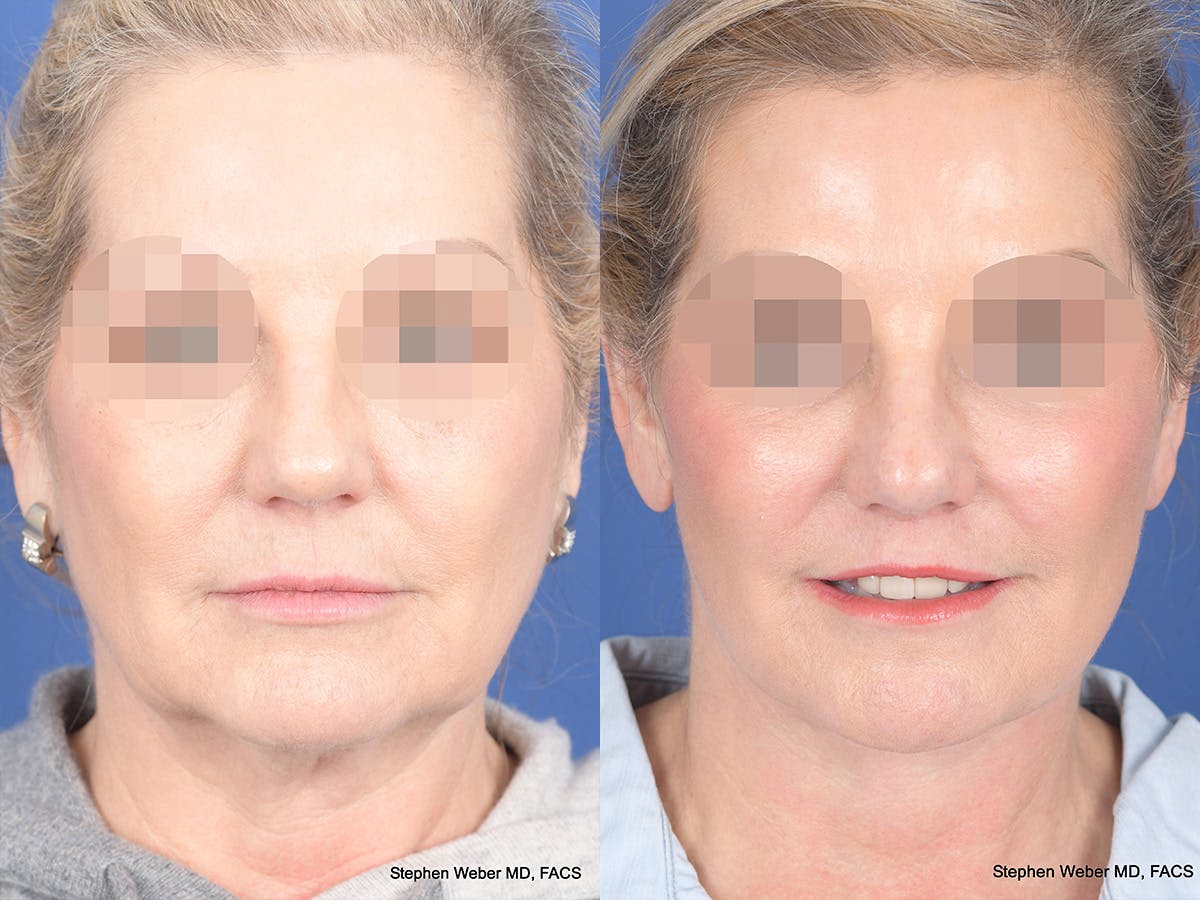 Fat Transfer Before & After Gallery - Patient 353776 - Image 1