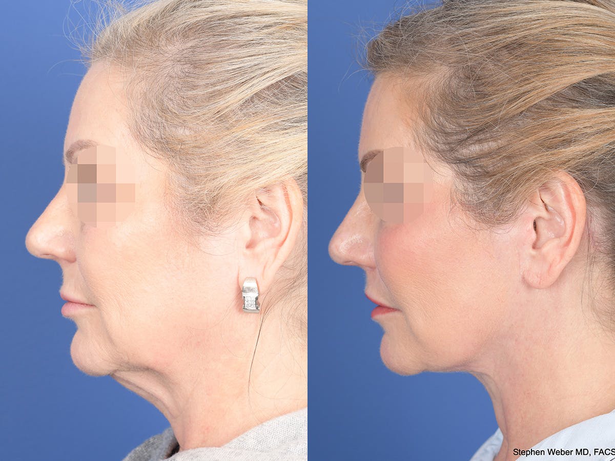 Fat Transfer Before & After Gallery - Patient 353776 - Image 2