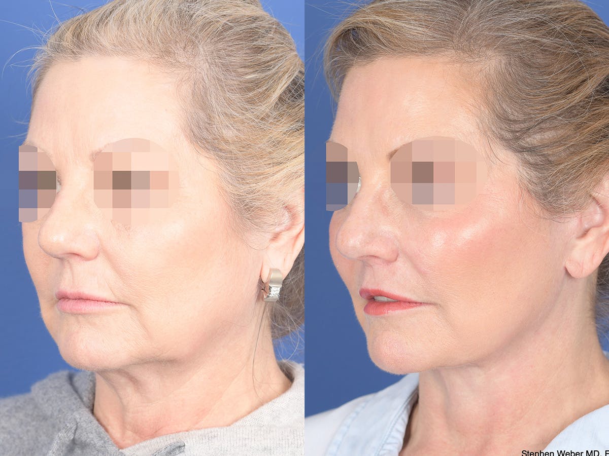Fat Transfer Before & After Gallery - Patient 353776 - Image 3