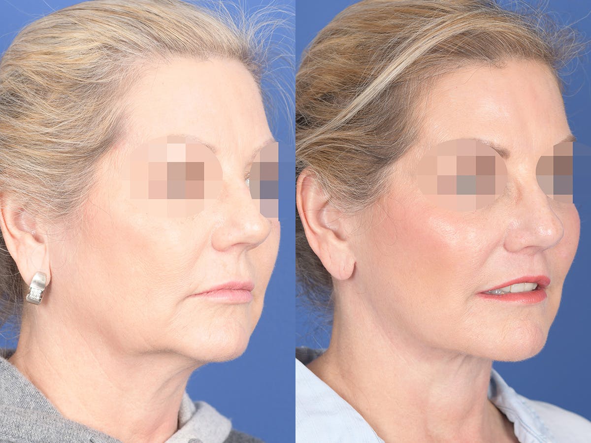 Fat Transfer Before & After Gallery - Patient 353776 - Image 4