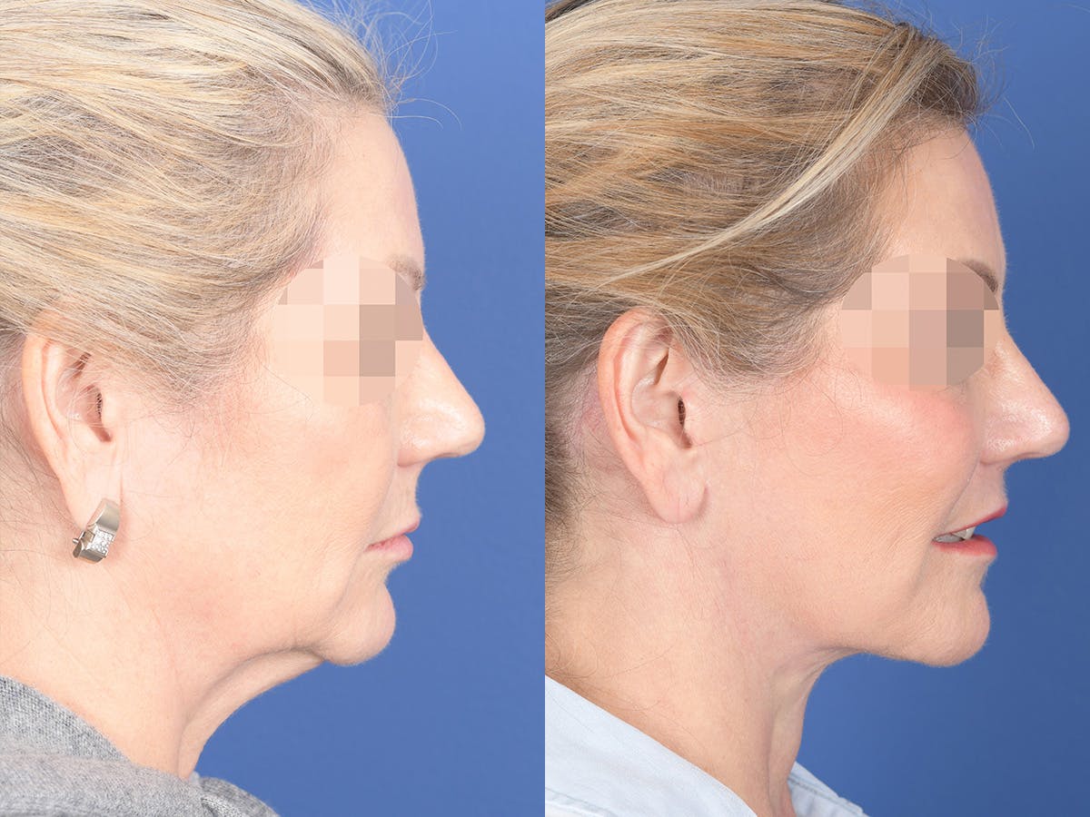 Fat Transfer Before & After Gallery - Patient 353776 - Image 5