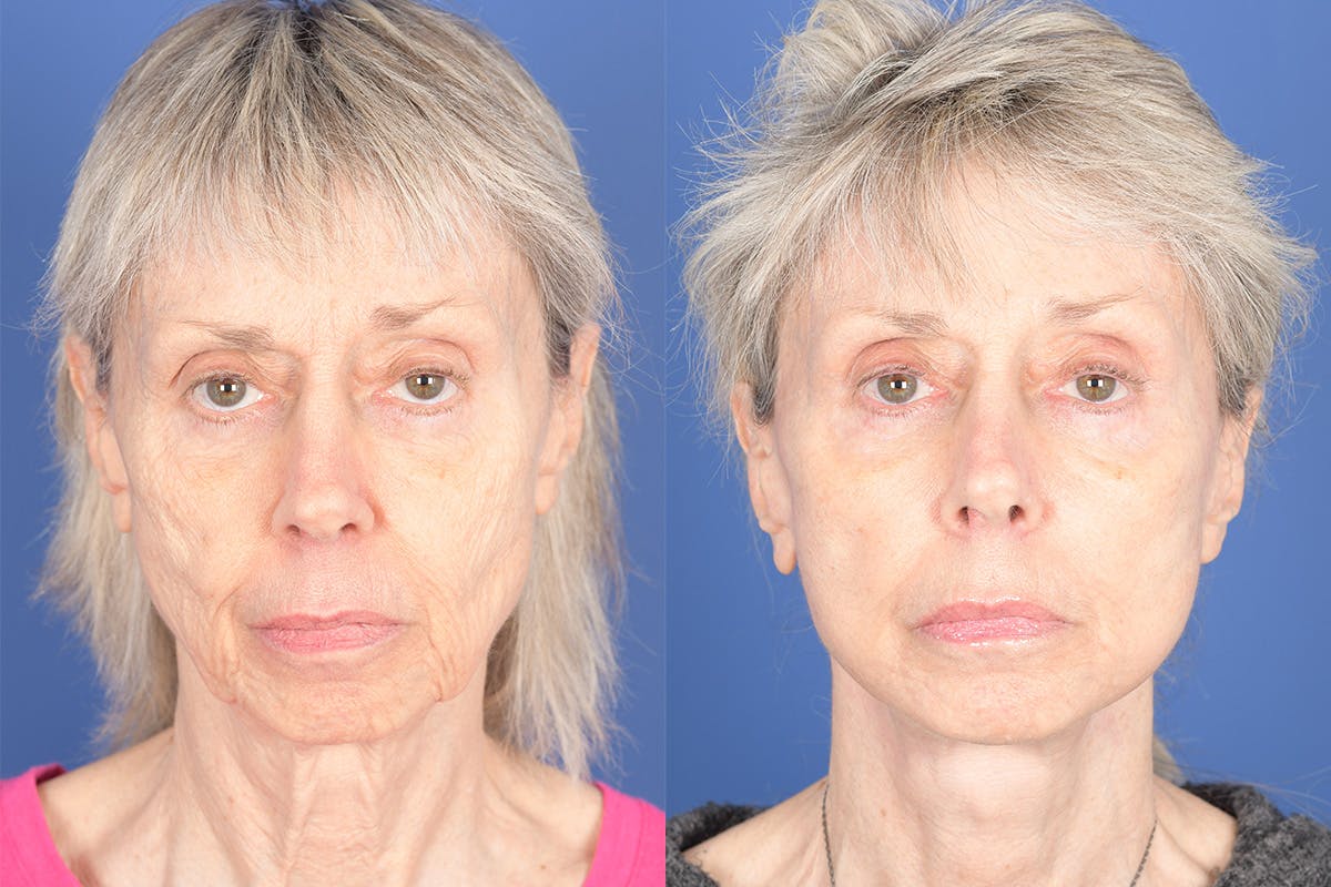 Facelift Before & After Gallery - Patient 348456 - Image 1