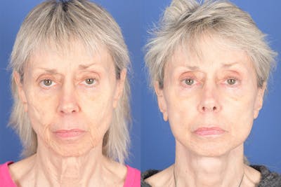 Facelift Before & After Gallery - Patient 348456 - Image 1