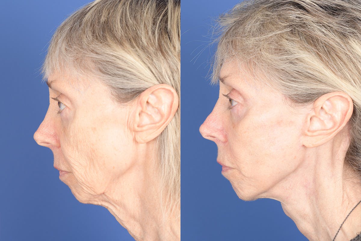 Facelift Before & After Gallery - Patient 348456 - Image 2