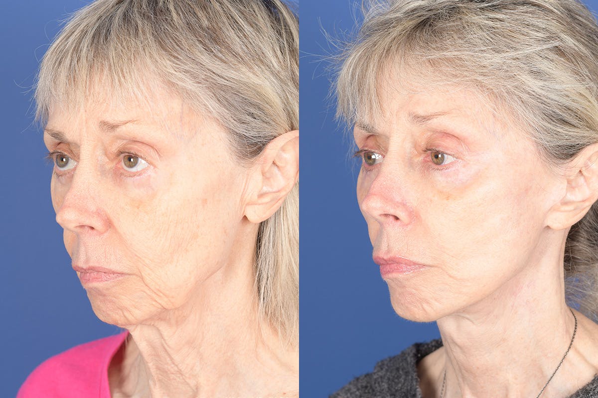 Facelift Before & After Gallery - Patient 348456 - Image 3