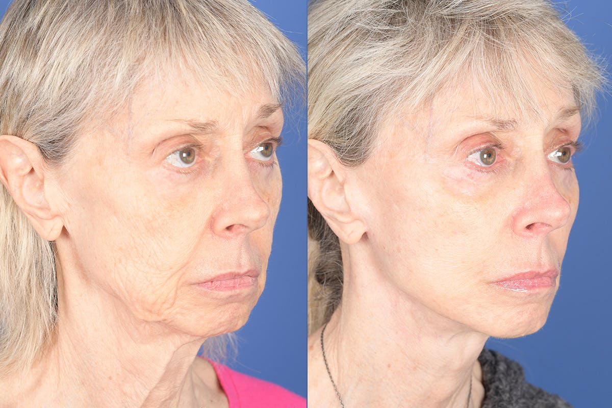 Facelift Before & After Gallery - Patient 348456 - Image 4