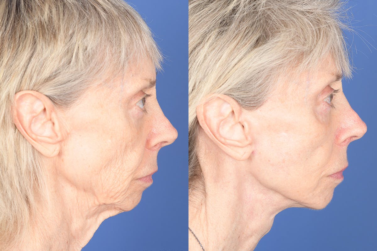 Facelift Before & After Gallery - Patient 348456 - Image 5