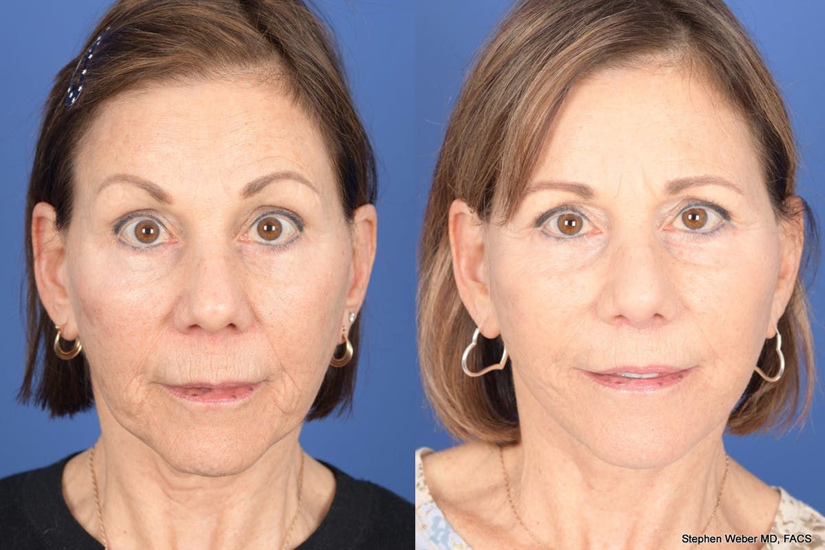 Facelift Before & After Gallery - Patient 179622 - Image 1
