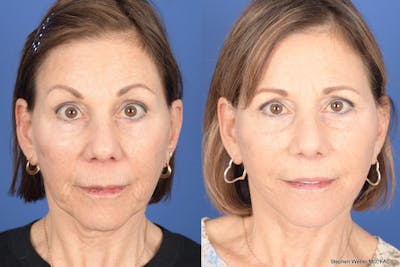 Facelift Before & After Gallery - Patient 179622 - Image 1