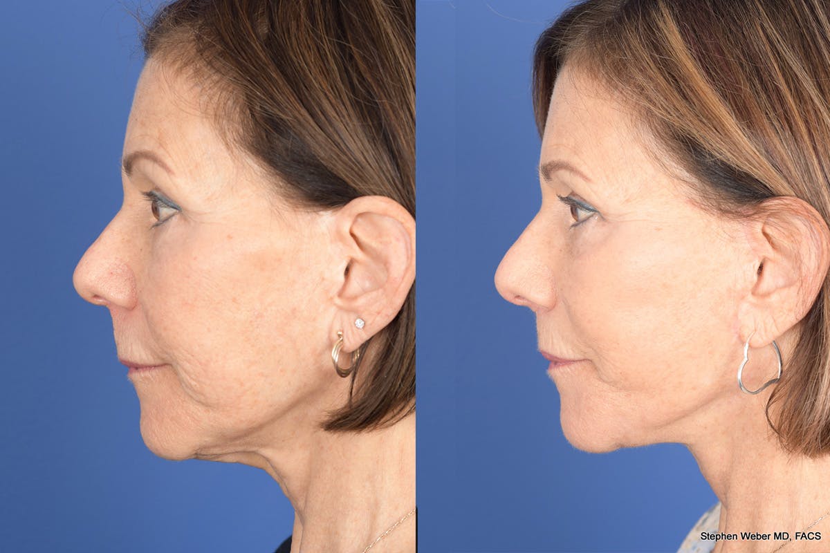 Facelift Before & After Gallery - Patient 179622 - Image 2