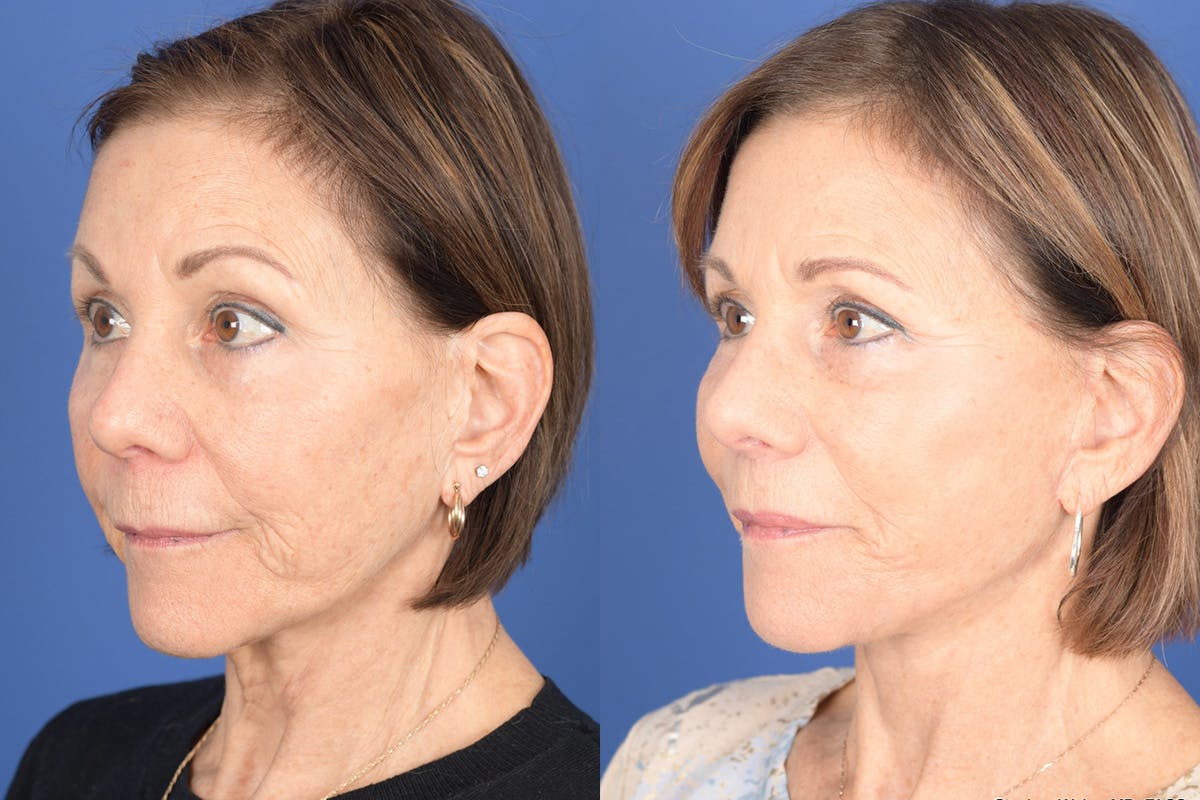 Facelift Before & After Gallery - Patient 179622 - Image 3