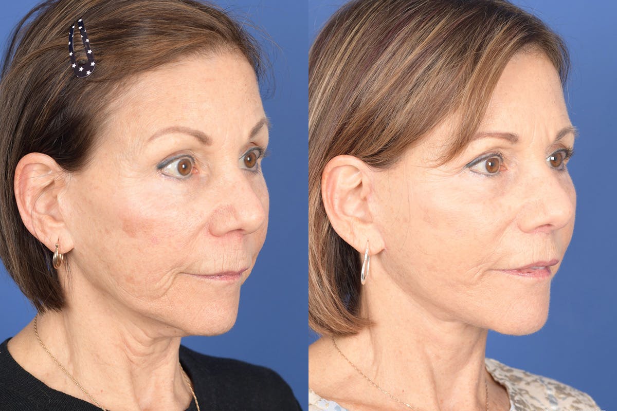 Facelift Before & After Gallery - Patient 179622 - Image 4