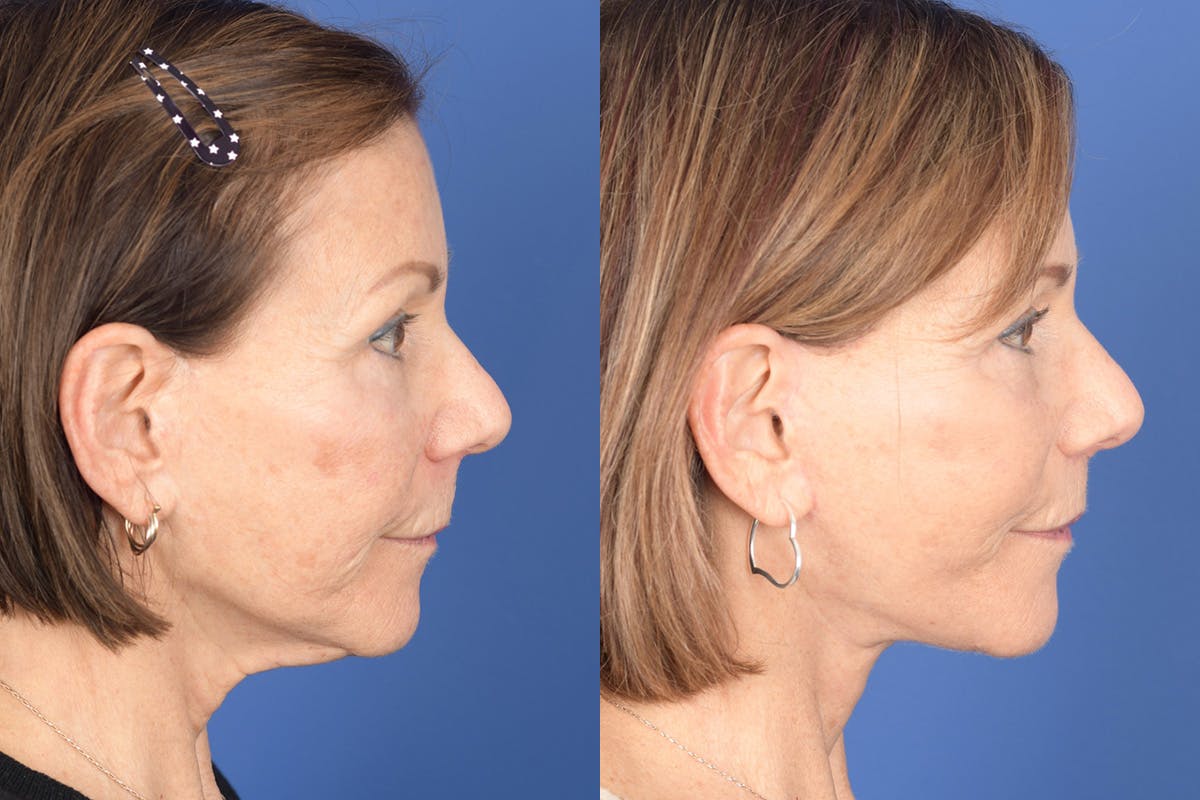 Facelift Before & After Gallery - Patient 179622 - Image 5