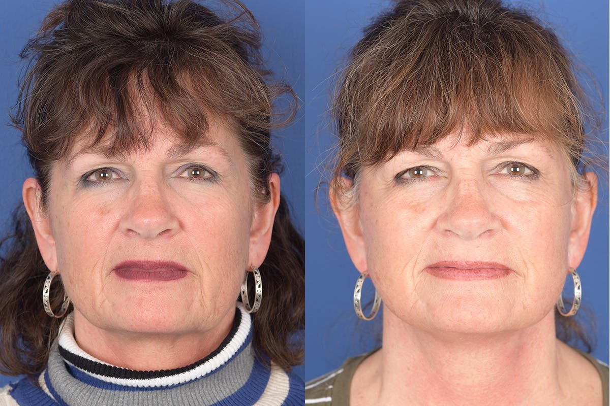 Facelift Before & After Gallery - Patient 137547 - Image 1