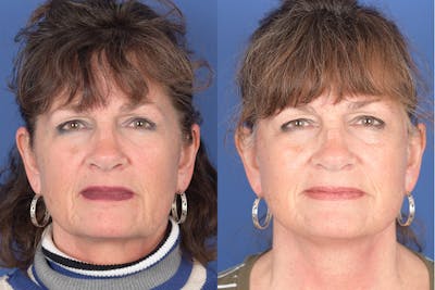 Facelift Before & After Gallery - Patient 137547 - Image 1