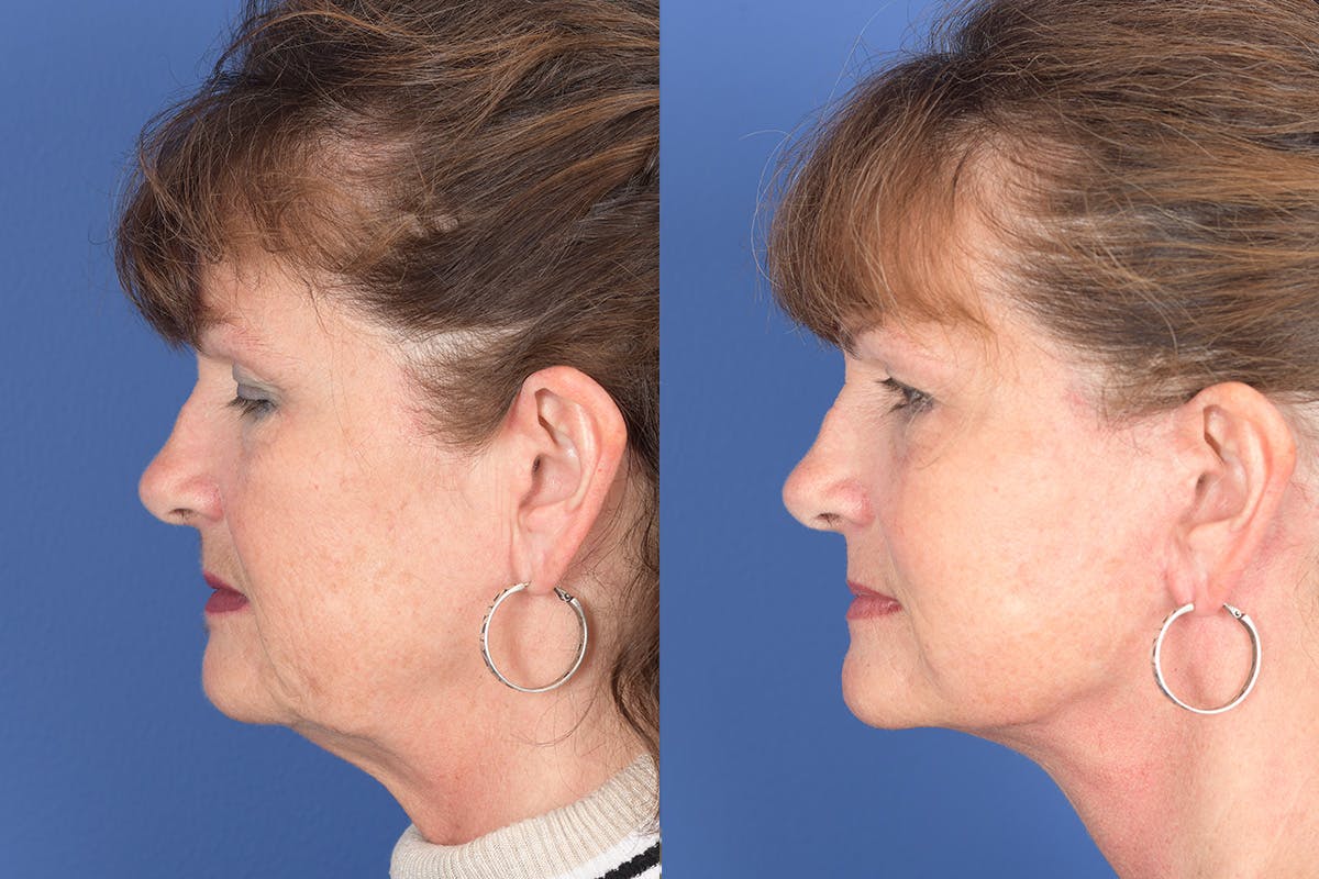 Facelift Before & After Gallery - Patient 137547 - Image 2