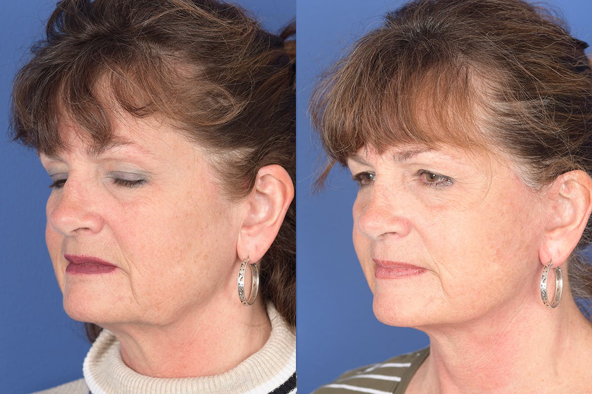 Facelift Before & After Gallery - Patient 137547 - Image 3