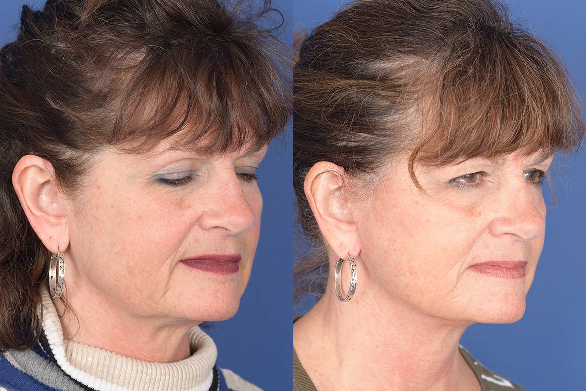 Facelift Before & After Gallery - Patient 137547 - Image 4