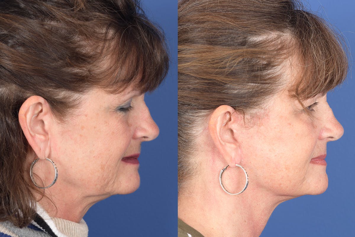 Facelift Before & After Gallery - Patient 137547 - Image 5