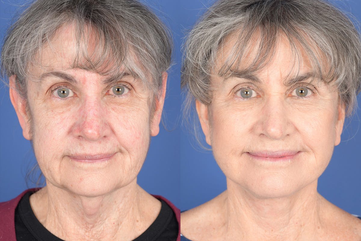 Facelift Before & After Gallery - Patient 274570 - Image 1