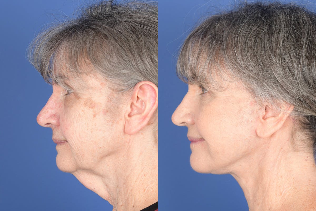 Facelift Before & After Gallery - Patient 274570 - Image 2