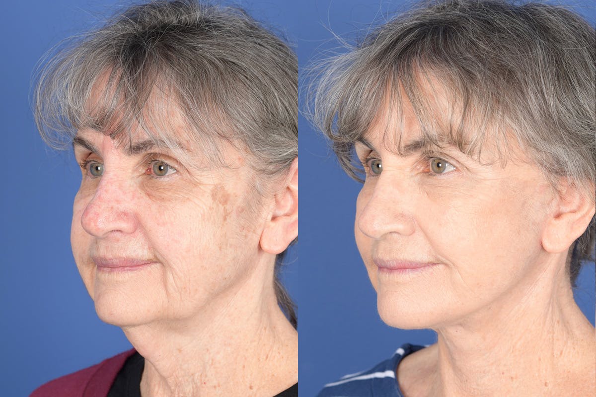Facelift Before & After Gallery - Patient 274570 - Image 3