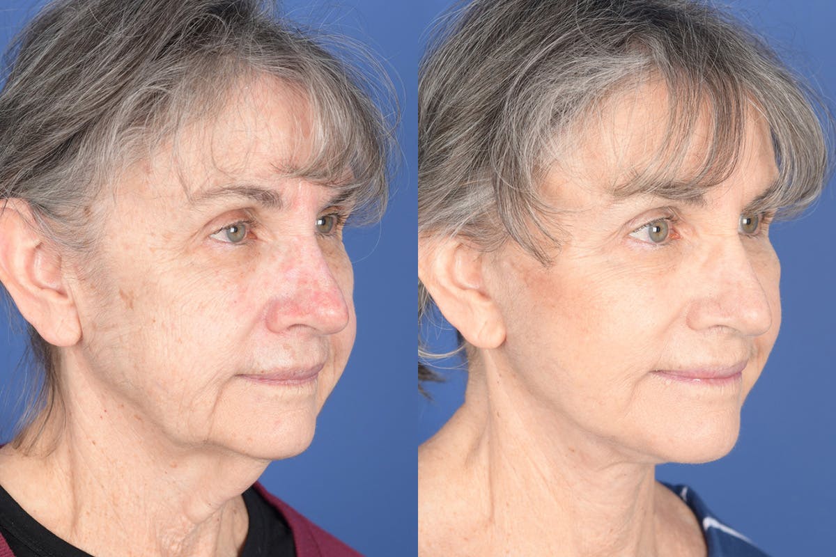 Facelift Before & After Gallery - Patient 274570 - Image 4