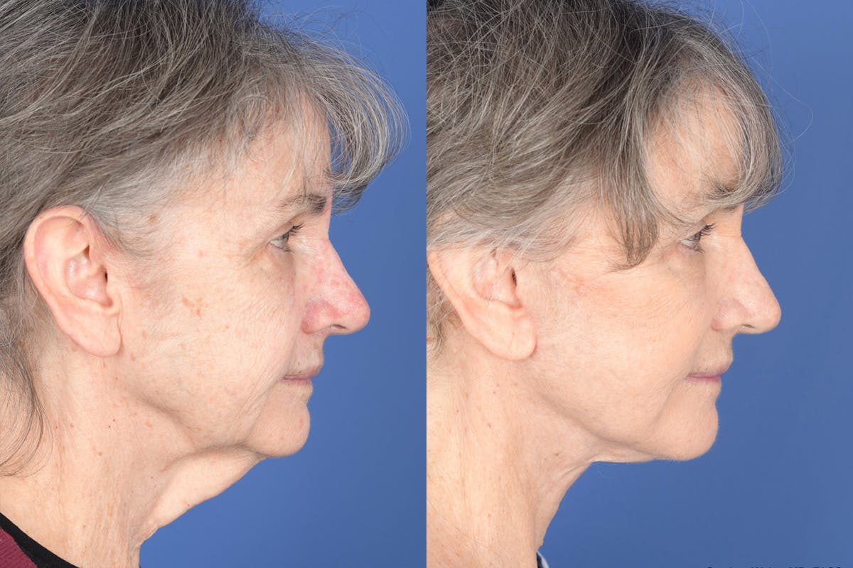 Facelift Before & After Gallery - Patient 274570 - Image 5