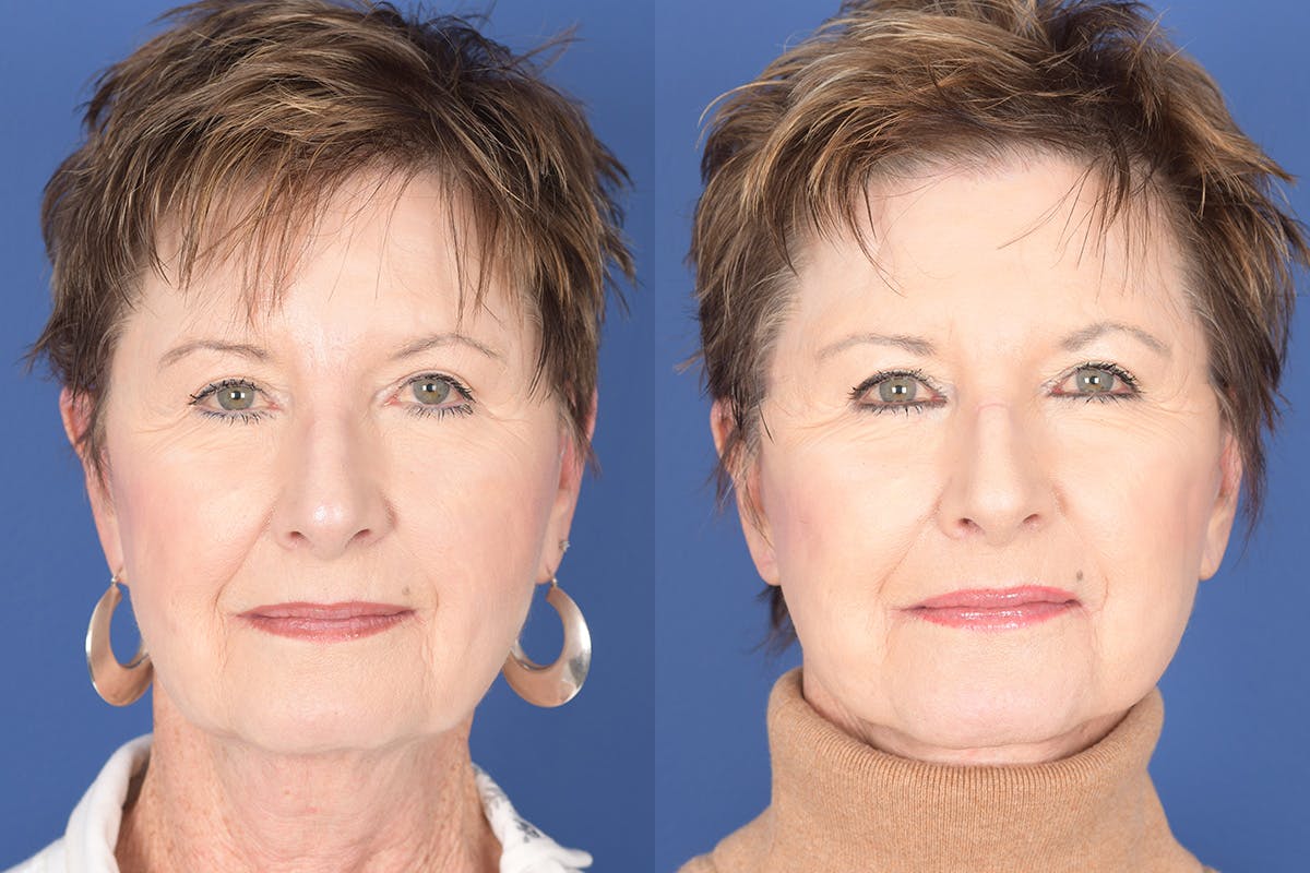 Facelift Before & After Gallery - Patient 133839 - Image 1