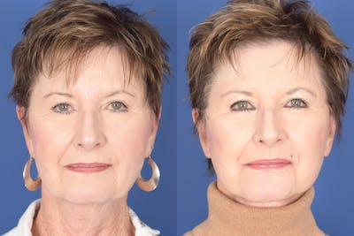 Facelift Before & After Gallery - Patient 133839 - Image 1