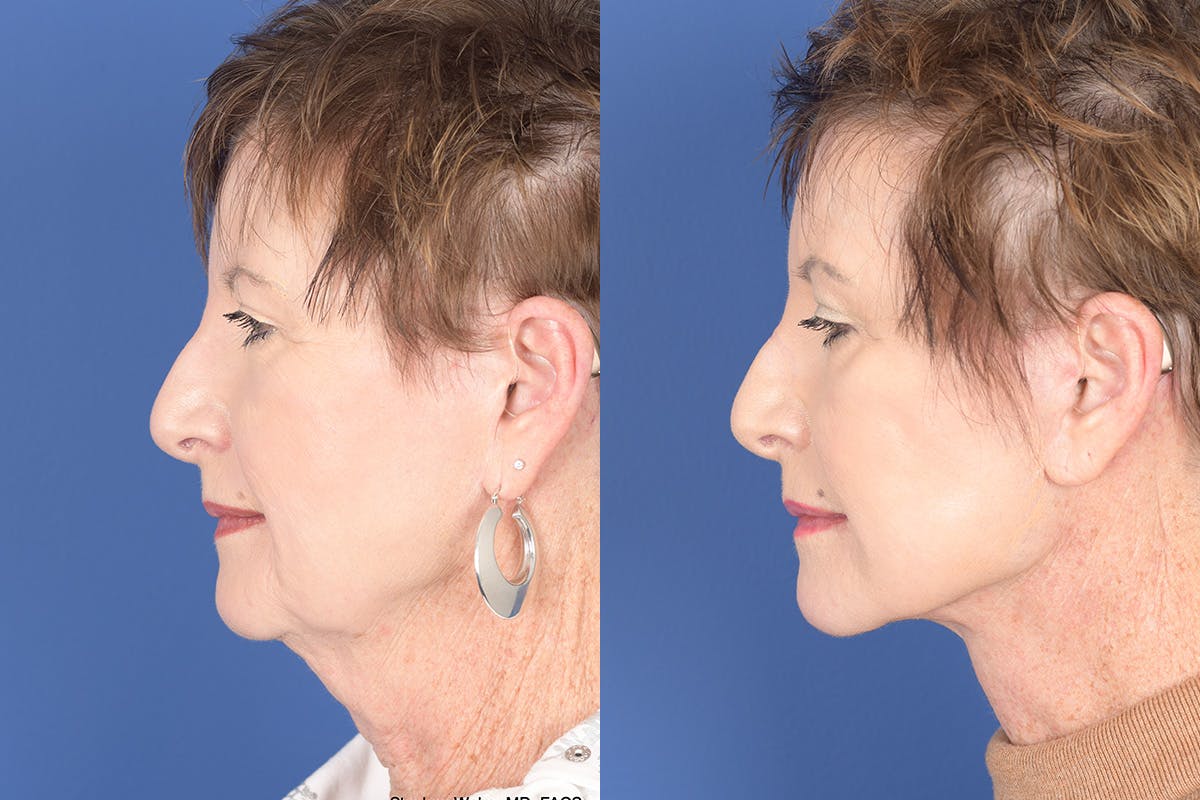 Facelift Before & After Gallery - Patient 133839 - Image 2