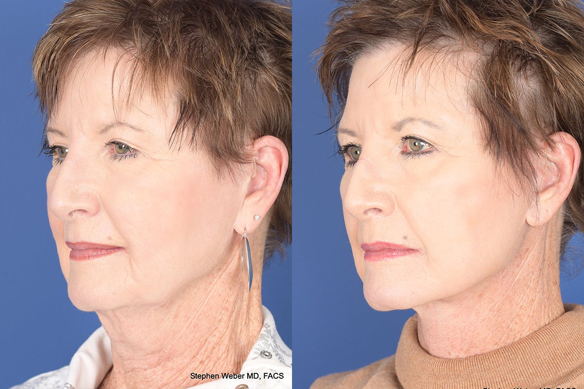 Facelift Before & After Gallery - Patient 133839 - Image 3