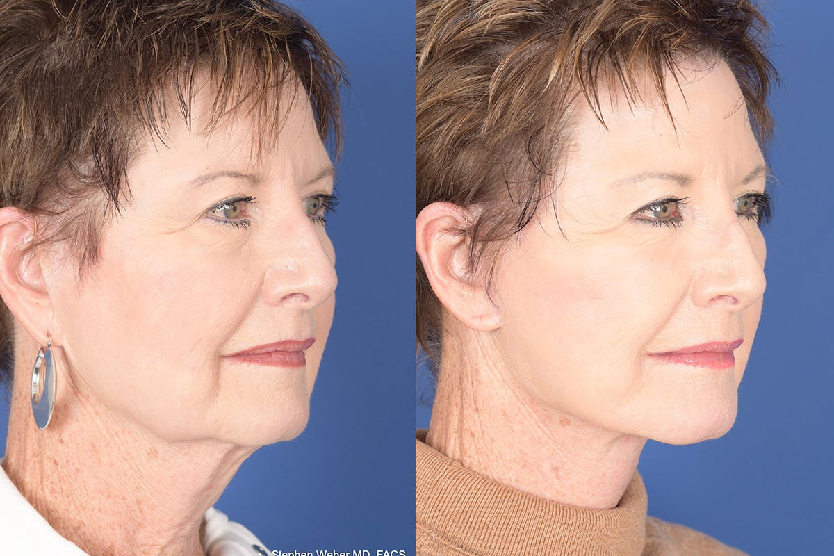 Facelift Before & After Gallery - Patient 133839 - Image 4
