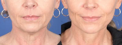 Facelift Before & After Gallery - Patient 197701 - Image 1