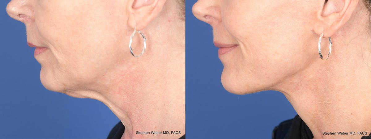 Facelift Before & After Gallery - Patient 197701 - Image 2