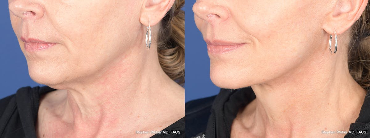Facelift Before & After Gallery - Patient 197701 - Image 3