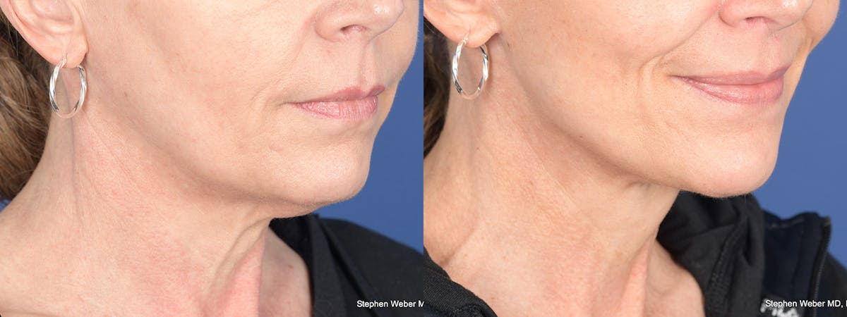 Facelift Before & After Gallery - Patient 197701 - Image 4