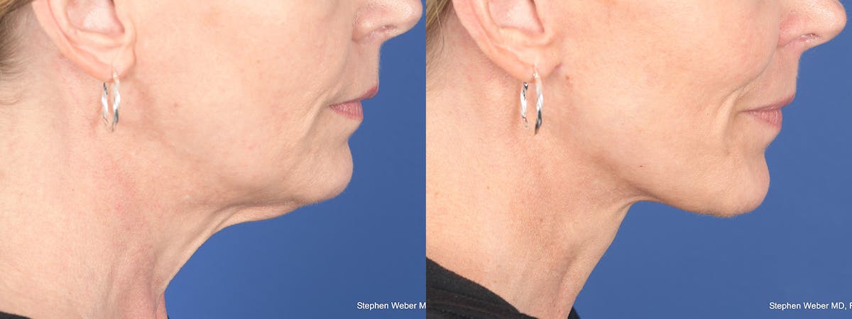 Facelift Before & After Gallery - Patient 197701 - Image 5