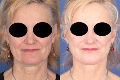 Facelift Before & After Gallery - Patient 134295 - Image 1