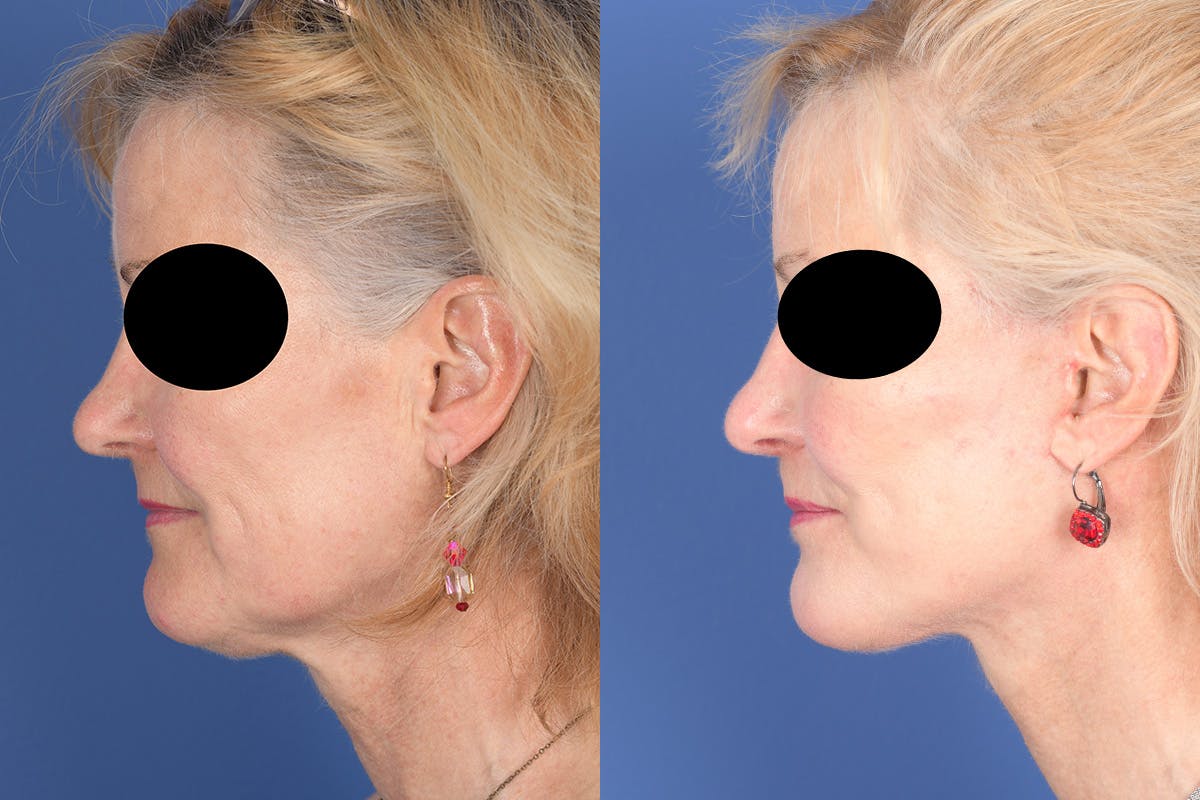 Facelift Before & After Gallery - Patient 134295 - Image 2