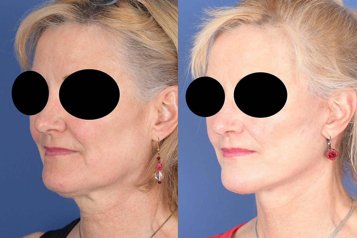 Facelift Before & After Gallery - Patient 134295 - Image 3