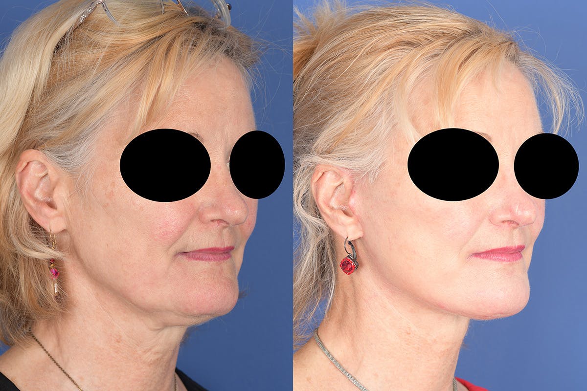 Facelift Before & After Gallery - Patient 134295 - Image 4