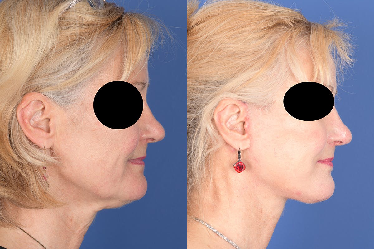 Facelift Before & After Gallery - Patient 134295 - Image 5