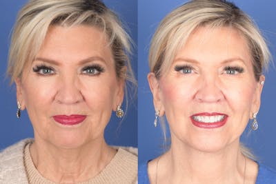 Facelift Before & After Gallery - Patient 395824 - Image 1