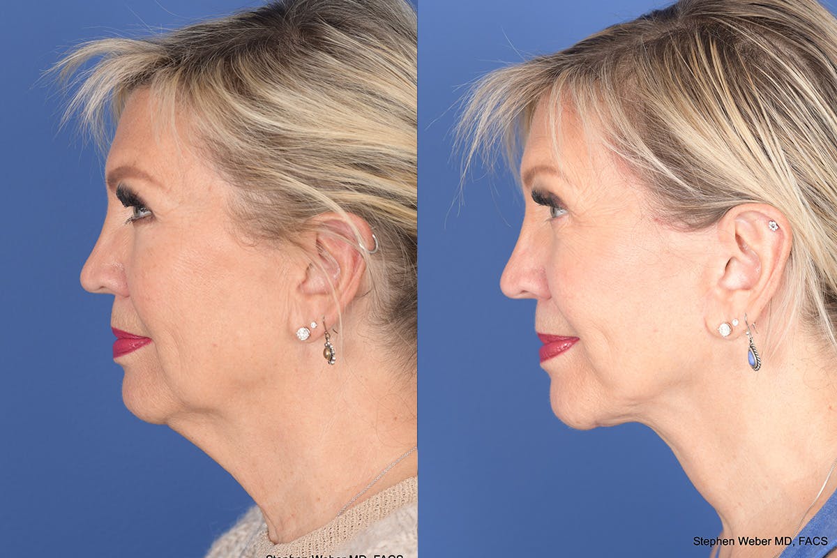 Facelift Before & After Gallery - Patient 395824 - Image 2