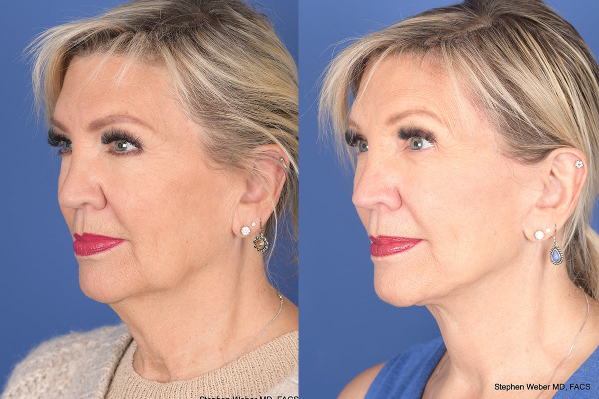 Facelift Before & After Gallery - Patient 395824 - Image 3