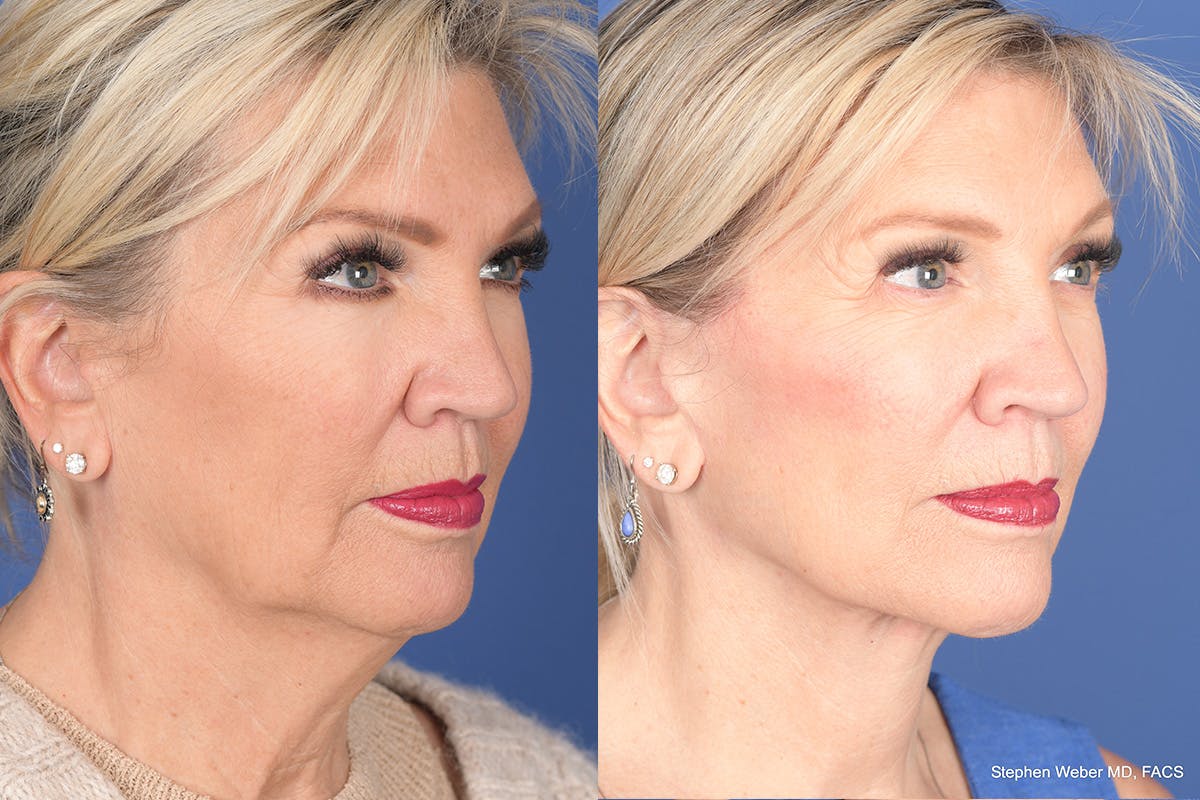Facelift Before & After Gallery - Patient 395824 - Image 4